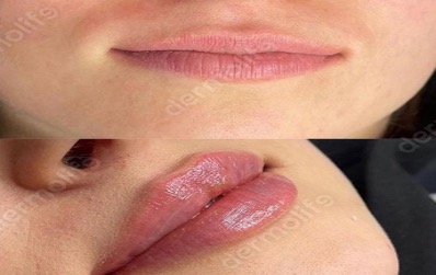 lip-filler-academy